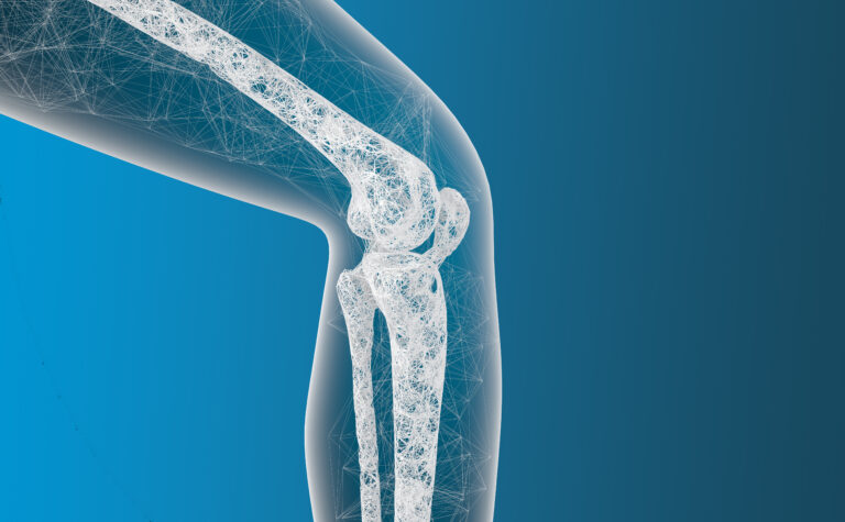 Uni Knee Replacement: A Targeted Solution for Knee Pain and Dysfunction