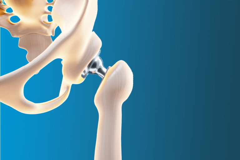 Embracing Mobility: A Guide to Hip Replacement Surgery