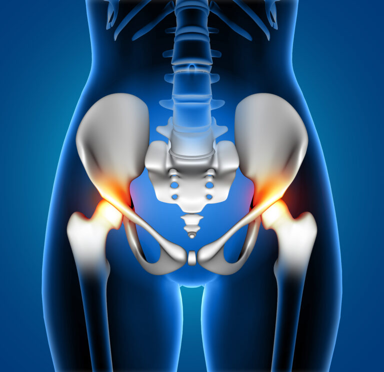 Understanding Hip Osteoarthritis: Causes, Symptoms, and Prevention