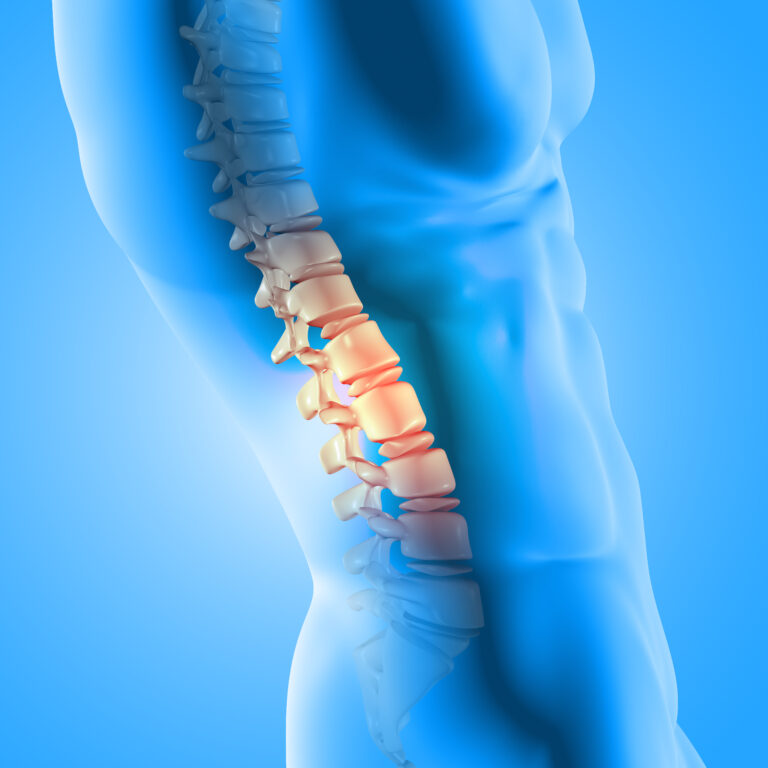 Avascular Necrosis: Causes, Risk, Symptoms, and when to see a doctor