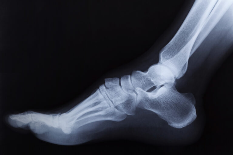 Surgical Procedure for Total Hip Replacement (THR)