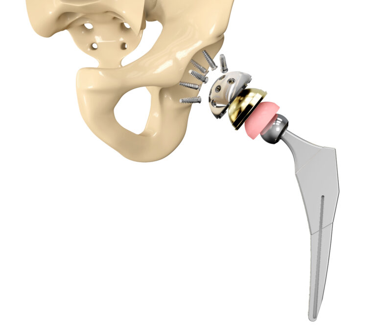 Recovery From A Hip Fracture Surgery