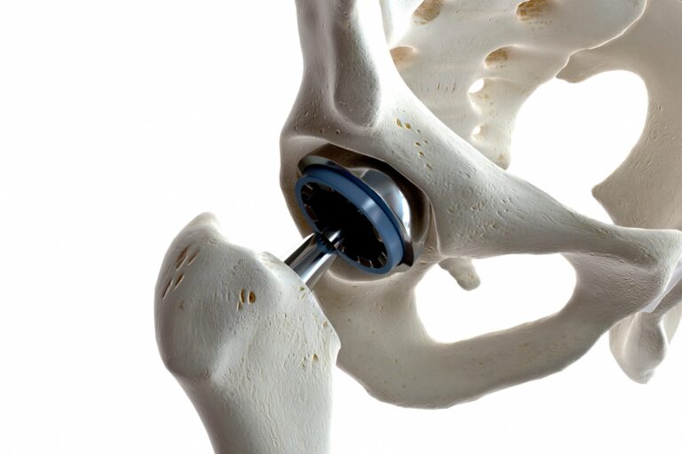 Understanding Hip Pain and Problems from Injuries and Arthritis