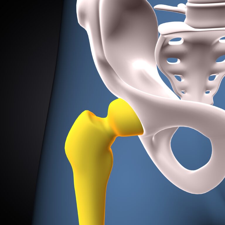 What are the Risks of Delaying Hip Replacement Surgery?