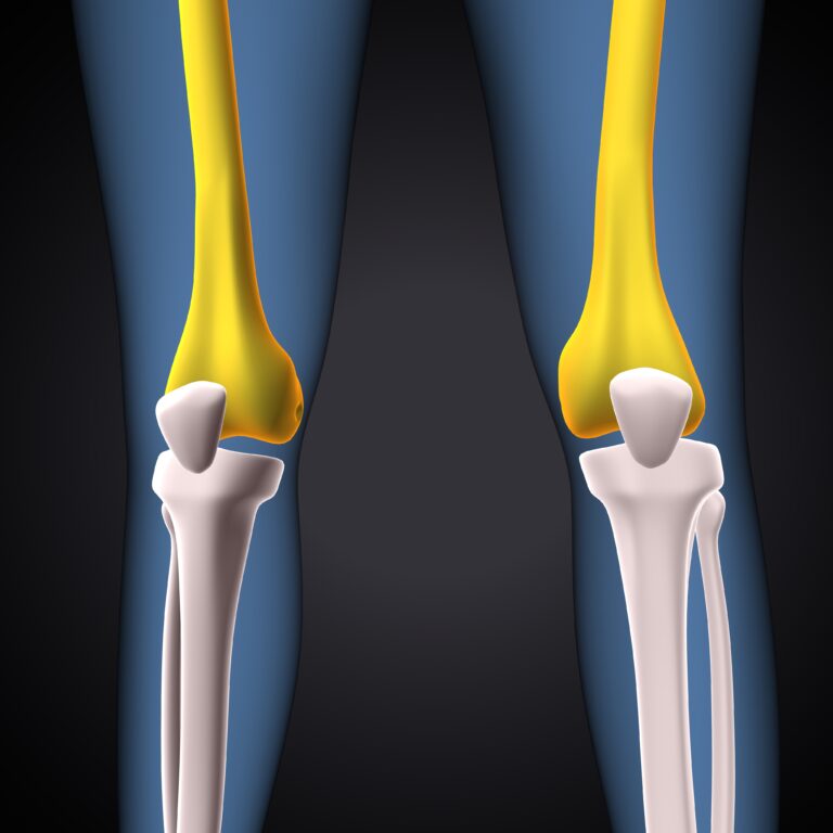 Can Early Osteoarthritis (OA) be Reversed?