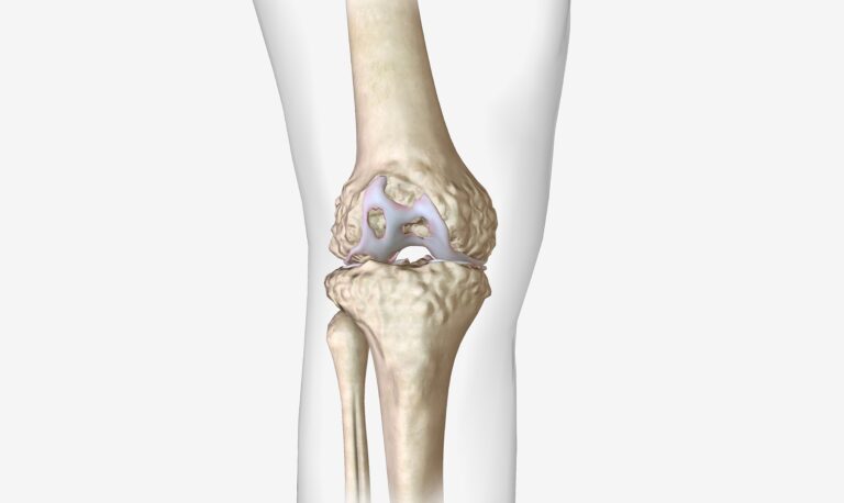 Minimally Invasive Surgery (MIS) For Knee Replacement