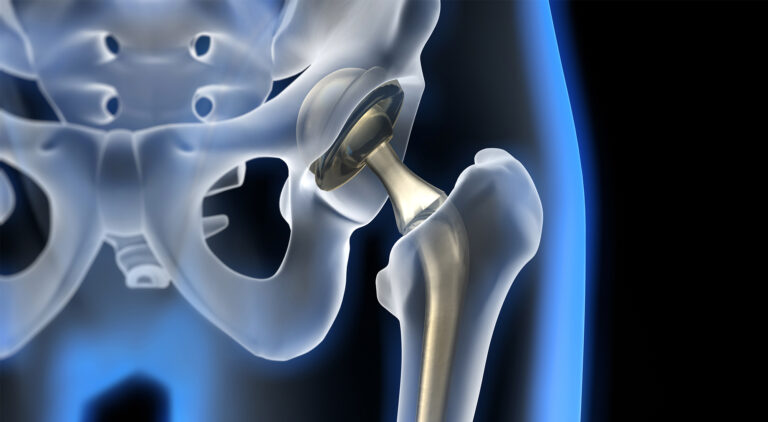 Deciding Between Partial and Total Knee Replacement: A Comprehensive Guide