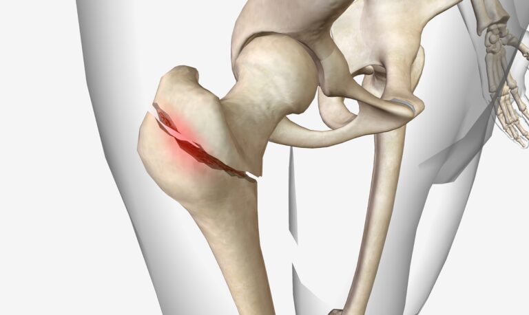 Exploring the Different Types of Hip Replacement Surgeries:  Which One is Right for You?