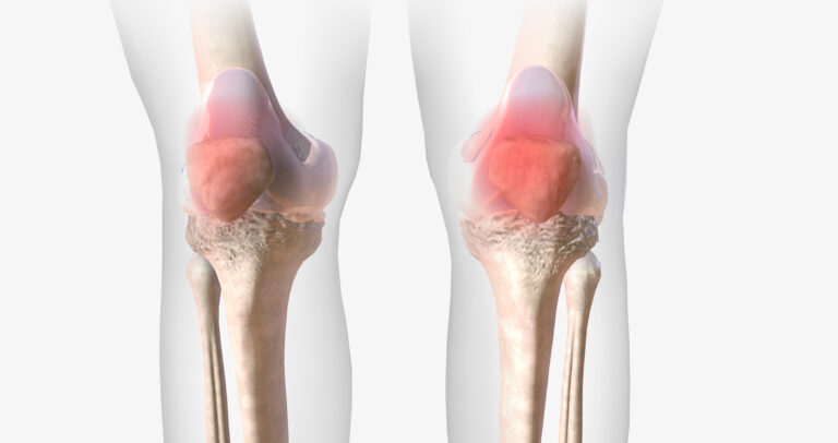 Rheumatoid Arthritis (RA): A Chronic Autoimmune Inflammatory Condition