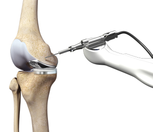 Navigating Knee Replacement with Robotic Surgery: Challenges and Solutions for Elderly Patients